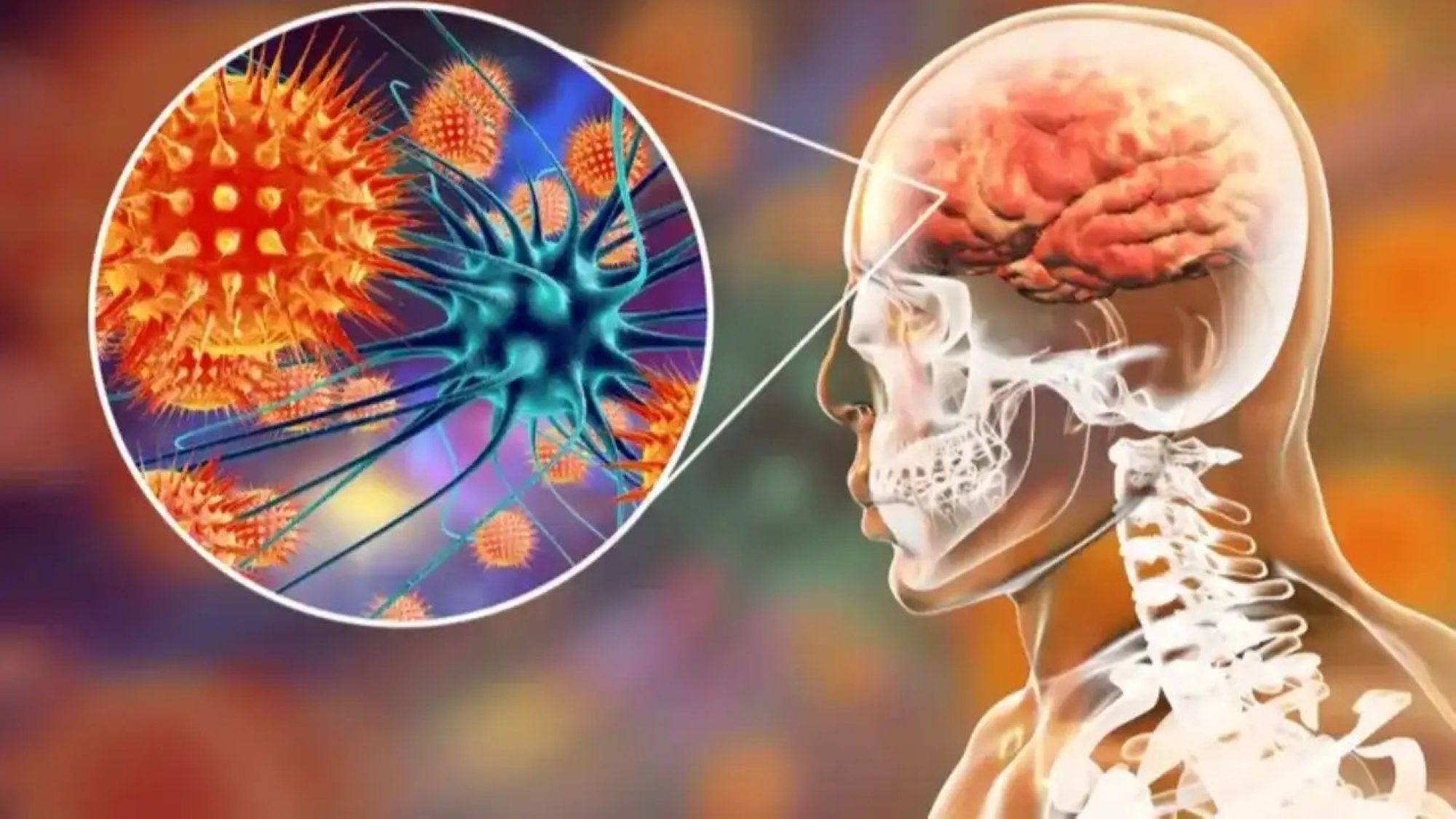 لا يوجد حتى الآن علاج محدد أو لقاح معتمد ضد فيروس نيباه